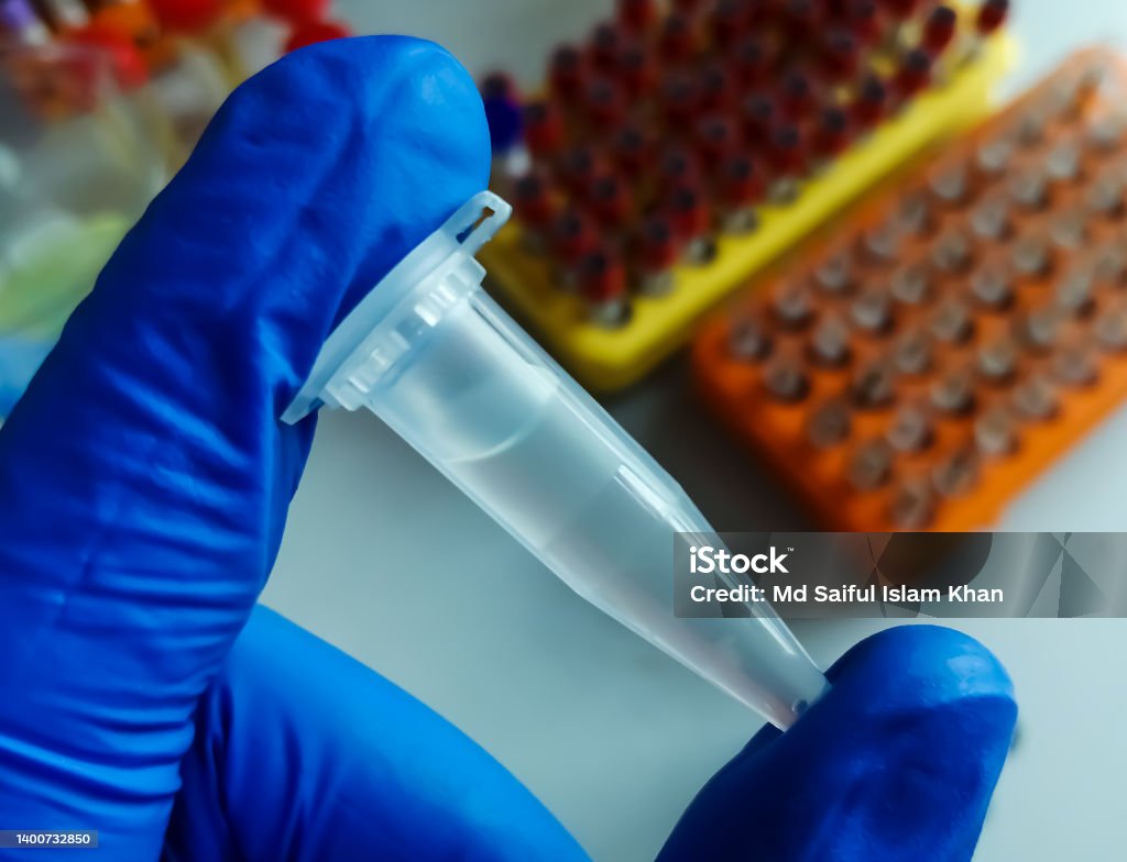 Eppendorf Tube with Cerebrospinal fluid (CSF) sample for pathological study including biochemistry, cytology, Gram staining. Anxiety Stock Photo