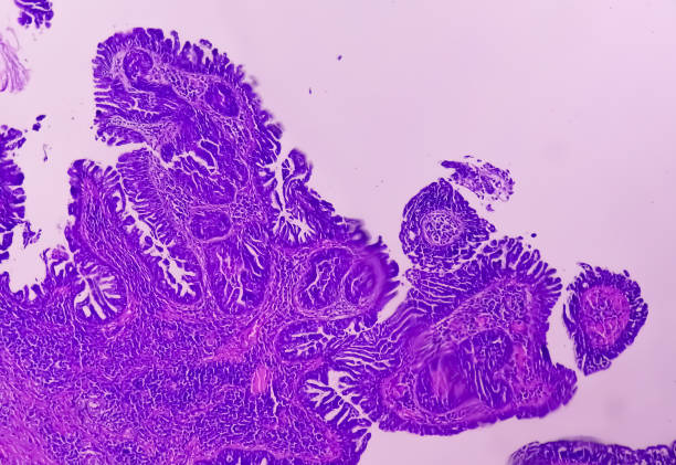 histologiczny szkiełko pod mikroskopią ukazujące brodawczak płaskonabłonkowy szypułkowy. - histology zdjęcia i obrazy z banku zdjęć