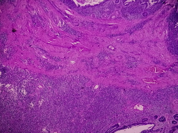 istock Histological slide under microscopy showing Pedunculated squamous papilloma. 1400733596