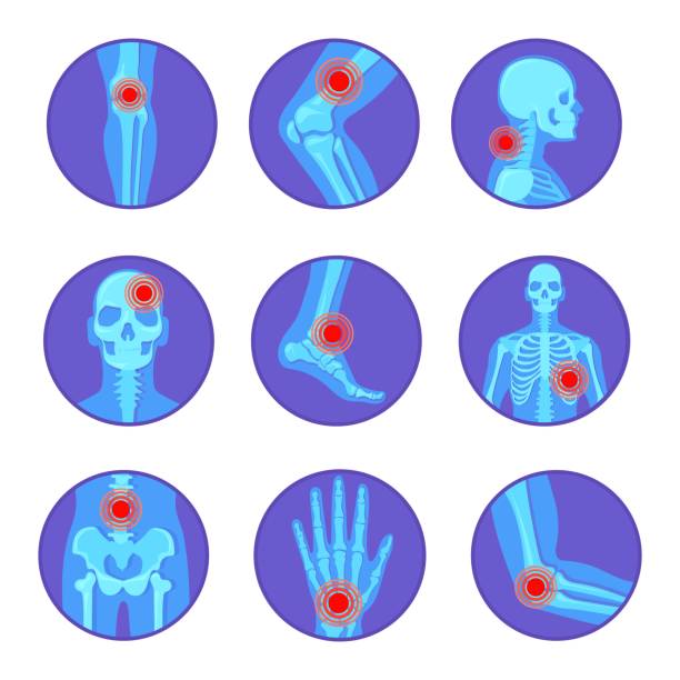 illustrations, cliparts, dessins animés et icônes de maladies articulaires orthopédiques. douleur rhumatoïde os genou main coude arthrite, rhumatologie squelette humain corps radiographie médecine chirurgie pied crâne bassin dessin animé vecteur soigné illustration - human knee pain human spine human joint