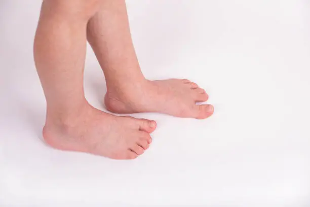 Photo of Syndactyly. Fused toes of a child, on a light background