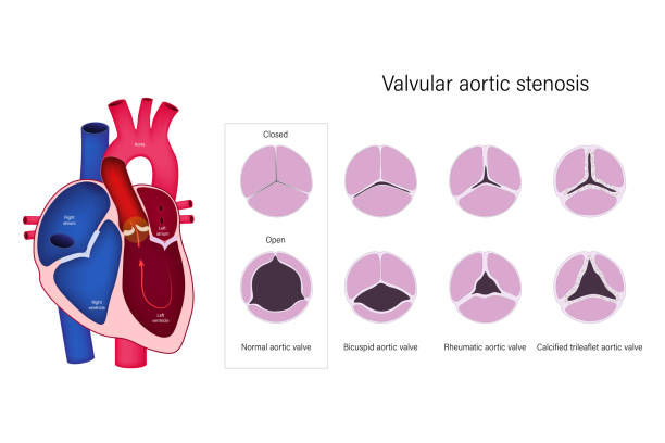 ilustrações, clipart, desenhos animados e ícones de estenose aórtica valvular. válvula aórtica normal, válvula aórtica bicusíptica, válvula aórtica reumática e válvula aórtica trileaflet calcificada. - endocardite