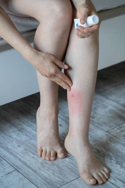 Girl sitting on bed at home applying cream on swollen skin leg from mosquito or midge bites. Allergy Woman sitting on bed at home, applying cream or balm on swollen skin leg from mosquito or midge bites, suffering from allergic reaction and swelling, itchy sore. Individual intolerance to insect bites horse fly photos stock pictures, royalty-free photos & images