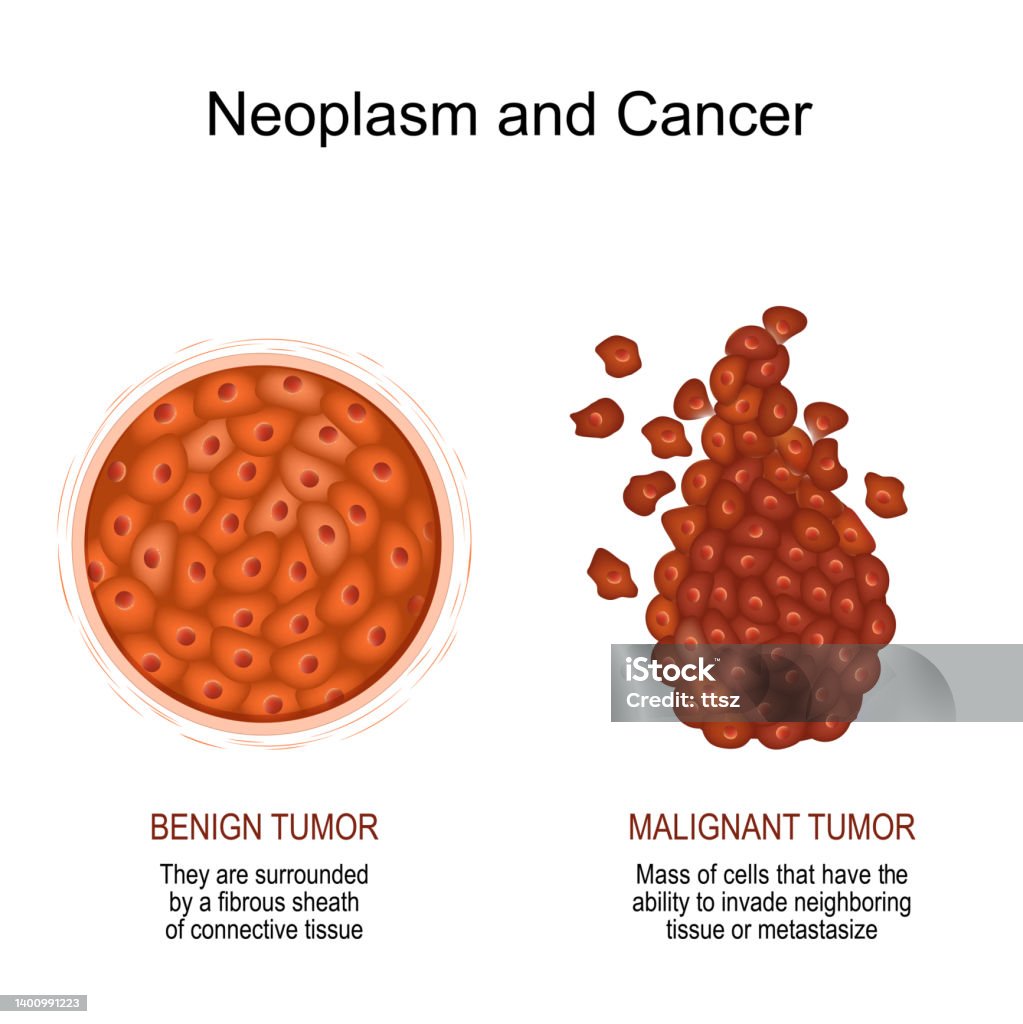 Neoplasm and Cancer. malignant and benign tumor. Neoplasm and Cancer. Comparison and difference of a malignant and benign tumor. benign tumor surrounded by a fibrous sheath of connective tissue. malignant Cancer is a Mass of cells that have the ability to invade neighboring tissue or metastasize. vector illustration Benign Tumor stock vector