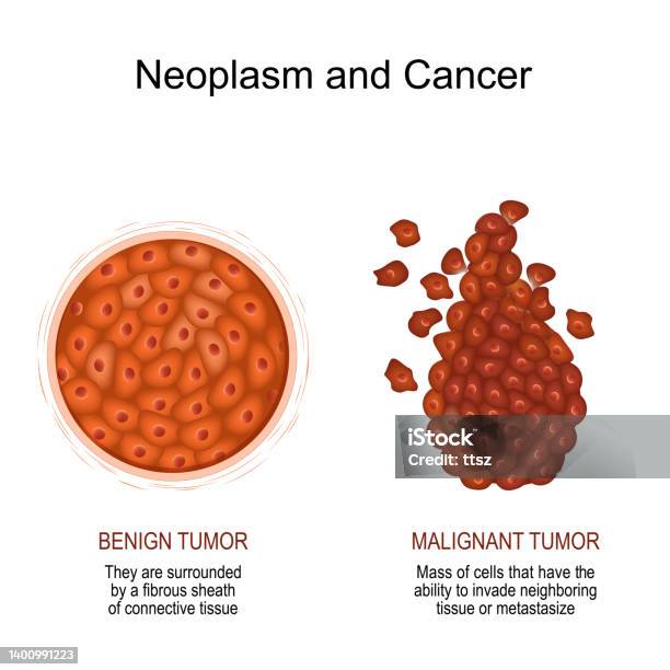 Neoplasm And Cancer Malignant And Benign Tumor Stock Illustration - Download Image Now - Benign Tumor, Tumor, Cancer - Illness