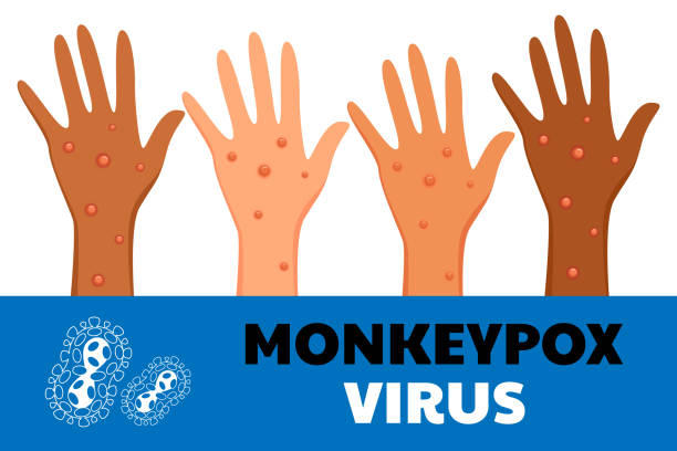 monkeypox virus poster. web banner of monkey pox skin infection of person. vector illustration. - 猴痘 插圖 幅插畫檔、美工圖案、卡通及圖標