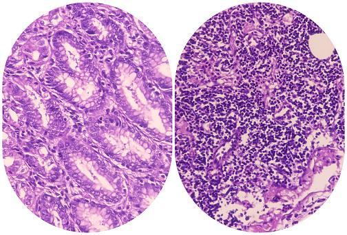 Human lymph node. Metastasis of a malignant melanoma. The normal lymphoid tissue of lymph node has completely disappeared and has been replaced by malignant melanoma pigmented and non-pigmented cells.