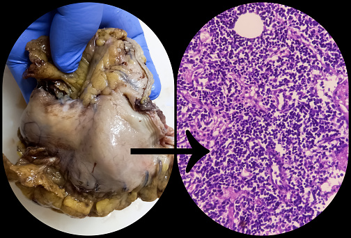 Stomach(biopsy): Lower partial gastrectomy sample with microscopic image show metastatic adenocarcinoma. Stomach cancer.