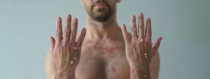 Manos masculinas afectadas por erupción con ampollas debido a la viruela del mono u otra infección viral sobre fondo blanco photo