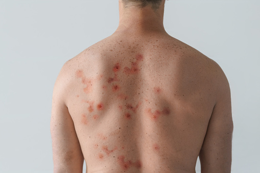 Espalda masculina afectada por erupción con ampollas debido a la viruela del mono u otra infección viral sobre fondo blanco photo