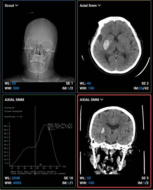 istock Head ct scan of bleeding stroke 1401158206