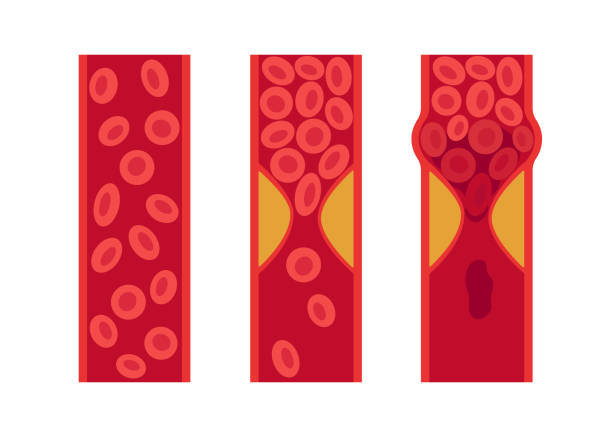 Normal and cholesterol-blocked artery. Blood clot, thrombus, atherosclerotic plaque. Deep vein thrombosis DVT or arterial clot, blood vascular flow. Blocked circulation in blood vessel. Vector Normal and cholesterol-blocked artery. Blood clot, thrombus, atherosclerotic plaque. Deep vein thrombosis DVT or arterial clot, blood vascular flow. Blocked circulation blood vessel. Vector clogged artery stock illustrations