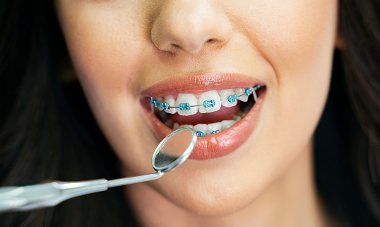 Closeup shot, young woman mouth with dental braces, dentist holding mirror tool. Mouth shot