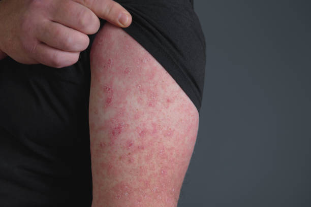 red rash on forearm. hand afflicted ermatophytosis on skin. erysipelas - wondroos stockfoto's en -beelden