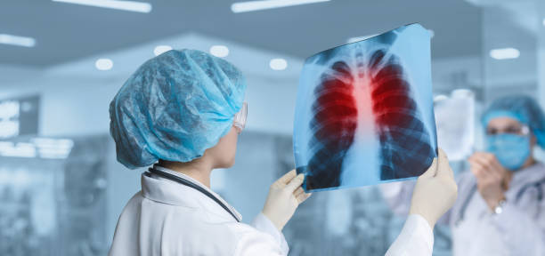 엑스레이를 찍은 의사가 폐를 검사합니다. - bronchitis 뉴스 사진 이미지