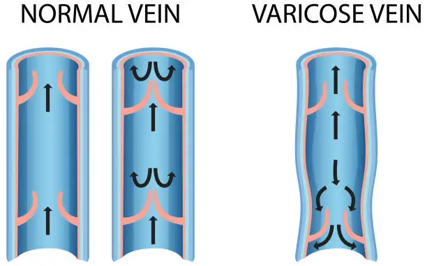 Vector illustration of A comparison of normal vein with varicose vein