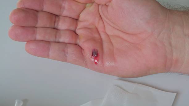 istock Caucasian Male Using Sharp Needle to Drain Blood from Hand Blister 1401480905