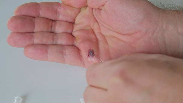 istock Caucasian Male Using Sharp Needle to Drain Blood from Hand Blister 1401480906