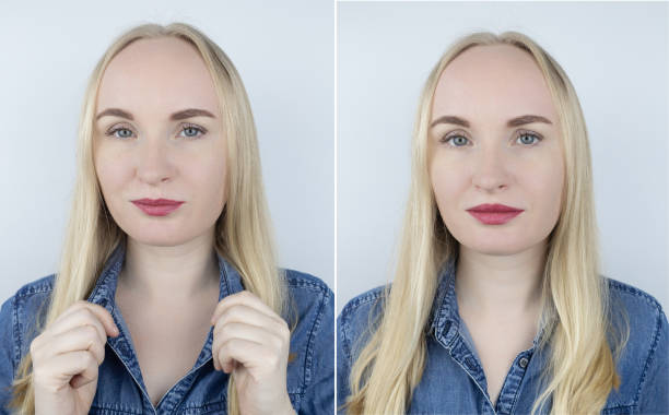 istock Lip augmentation. Before and after silicone injections in the lips. Professional cosmetologist increases the size. Visible result after professional manipulations to change the shape of the lips. Biopolymers 1401497063