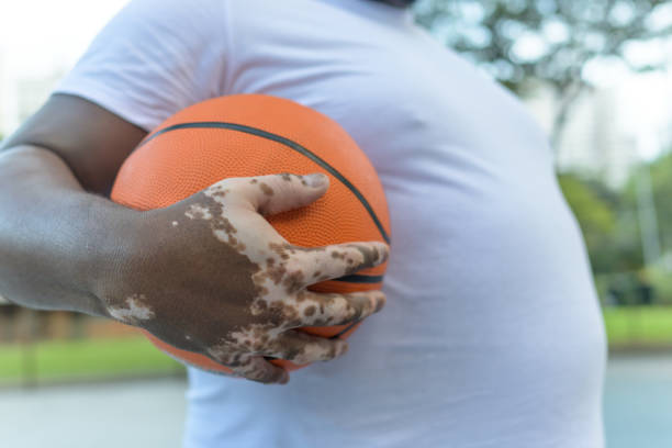 istock A man with vitiligo playing basketball 1401497257