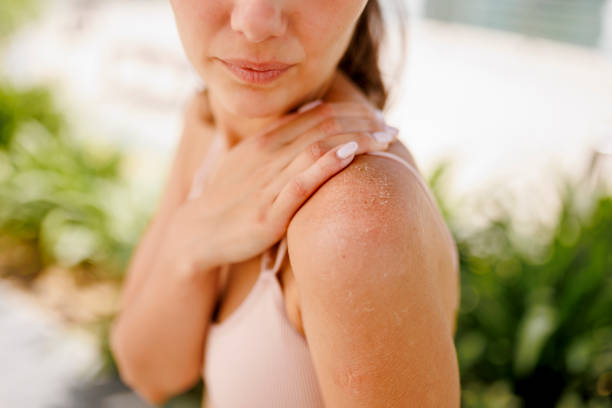 Females sunburned back Females sunburned back sunbathing stock pictures, royalty-free photos & images