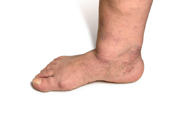 Swelling female leg with inflammation in diabetic nephropathy and varicose veins. Elderly woman's leg with hematoma and edema on white background. Closeup. Swelling female leg with inflammation in diabetic nephropathy and varicose veins. Elderly woman's leg with hematoma and edema on white background. Closeup blood clot photos stock pictures, royalty-free photos & images