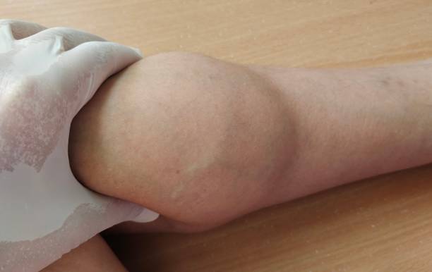 istock Calf muscles and blood vessels 1401692087