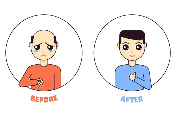 ilustrações, clipart, desenhos animados e ícones de homem personagem de desenho animado antes após tratamento de alopecia - alopecia homem