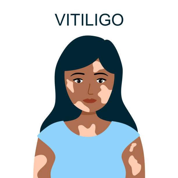 Vitiligo skin disease concept vector illustration. Woman with skin problem. Vitiligo skin disease concept vector illustration. Woman with skin problem. vitiligo stock illustrations