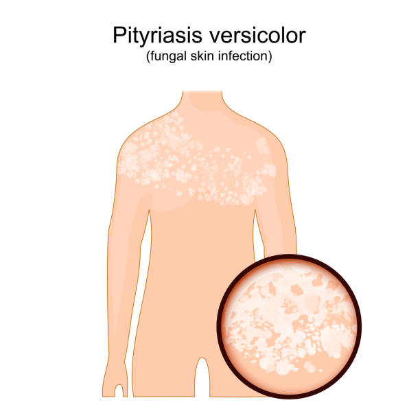 Tinea versicolor. Human body with symptoms of pityriasis versicolor. Tinea versicolor. Human body with symptoms of pityriasis versicolor. Close-up of skin that affected by a fungus. vector illustration lota stock illustrations
