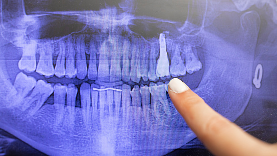 Detail of a digital dental panoramic radiograph, taken with x-ray, of a patient's mouth, showing the teeth, jaws and a dental implant