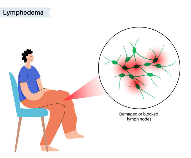 Lymphedema leg swelling Lymphedema disease concept. Swelling of female legs or arms. Damaged lymph nodes in human obesity body. Overweight problem and elephantiasis. Disorder in the lymphatic system flat vector illustration. obese joint pain stock illustrations