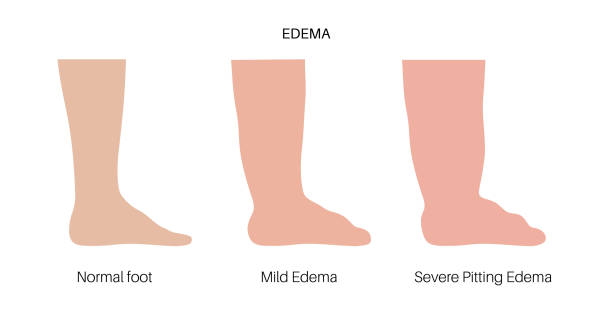 Edema of feet Edema disease concept. Oedema or fluid retention disorder. Inflammation in legs. Hydropsy, swelling and build up of fluid in the human body. Heavy and tight feeling in limbs vector illustration. obese joint pain stock illustrations