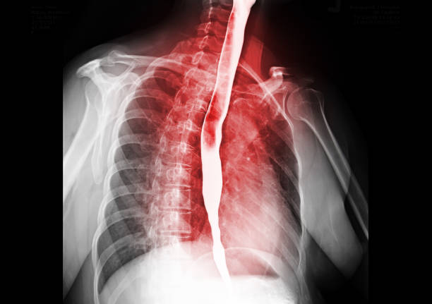 Esophagram. Esophagram or Barium swallow  showing esophagus for diagnosis GERD or Gastroesophageal reflux disease or Esophageal cancer. oesophagus stock pictures, royalty-free photos & images