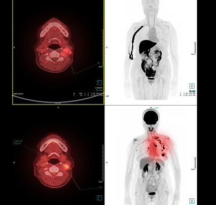 PET Scan image of Neck for detect lung cancer recurrence after surgery. medical technology concept.