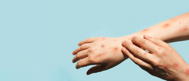 istock Monkeypox new disease dangerous over the world. Hands with Monkey Pox. Painful rash, red spots blisters on the hand. Close up rash, human hands with Health problem. Banner, copy space. 1401906523