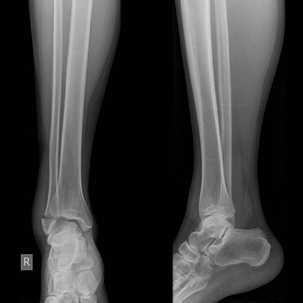istock growth plate fracture x ray, broken leg 1401932436