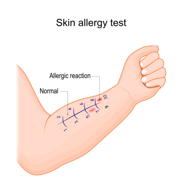 Skin allergy test. Human arm with allergen. Skin allergy test. Human arm with small amount of the allergen. normal reaction and immune response in the form of a rash. Vector illustration skin exame stock illustrations
