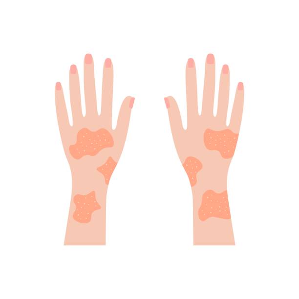 Hands covered with rash. Red psoriatic eruptions and inflamed eczema Hands covered with rash. Red psoriatic eruptions and inflamed eczema. Allergic urticaria problems and infectious vector smallpox infection erythema nodosum stock illustrations