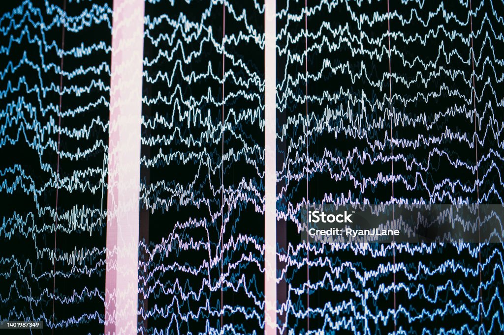 Brainwaves Imaged In Neurofeedback Treatment The electrical waves read from a girls brain show on a computer screen read out. Brain Wave Stock Photo