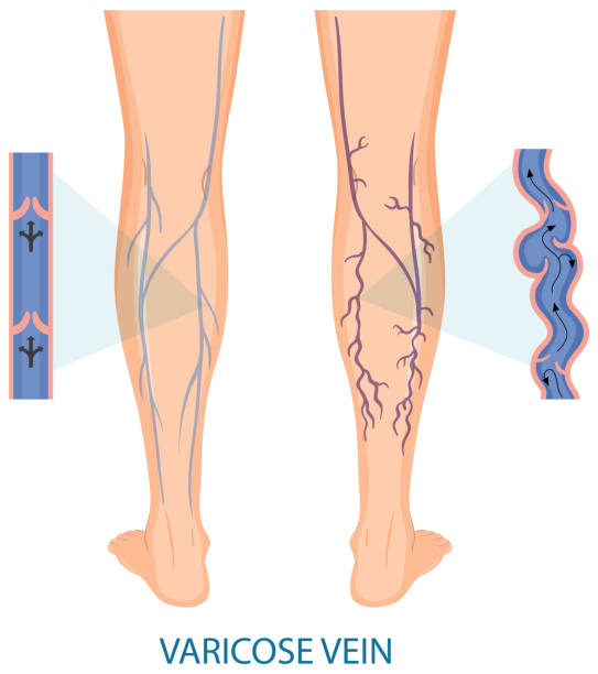 ilustraciones, imágenes clip art, dibujos animados e iconos de stock de piernas humanas con venas varicosas - human vein illustrations