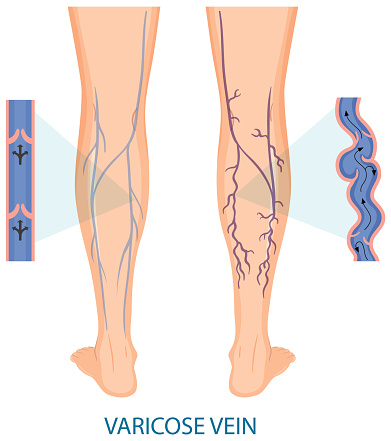 Human legs with varicose vein illustration
