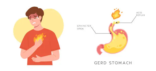 Vector illustration of Man suffering from GERD symptom with acid reflux because of sphincter opened stomach.