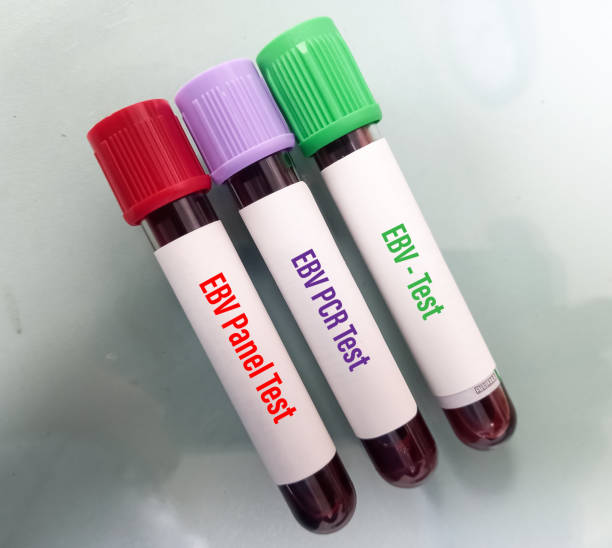 Blood test samples for EBV (Epstein-Barr virus) panel test, EBV PCR test, EBV test, to help diagnose EBV infection. Blood test samples for EBV (Epstein-Barr virus) panel test, EBV PCR test, EBV test, to help diagnose EBV infection. epstein barr virus photos stock pictures, royalty-free photos & images