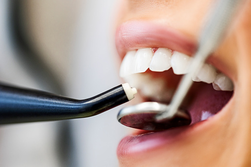 Close-up image of woman's mouth at dentist