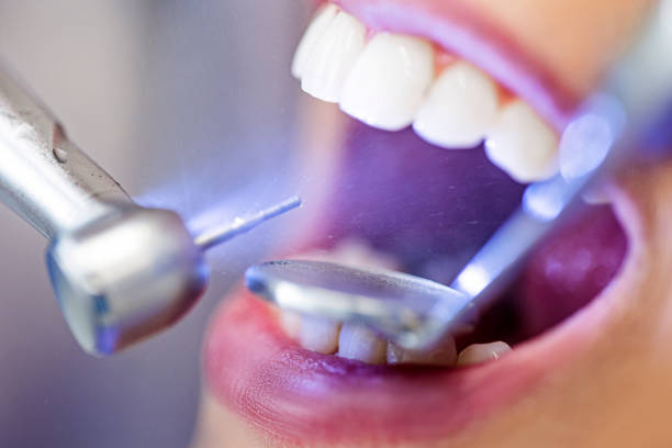 istock Dental drill in mouth close up 1402315993