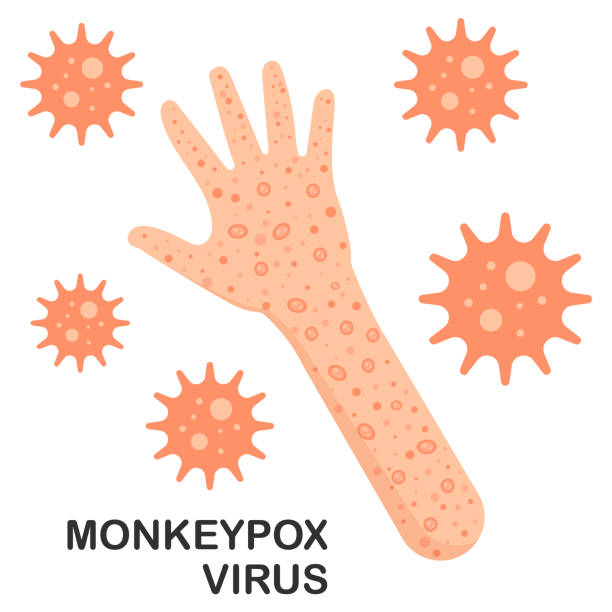 Smallpox Hand Image 230+ Smallpox Hand Stock Illustrations, Royalty-Free Vector Graphics ...