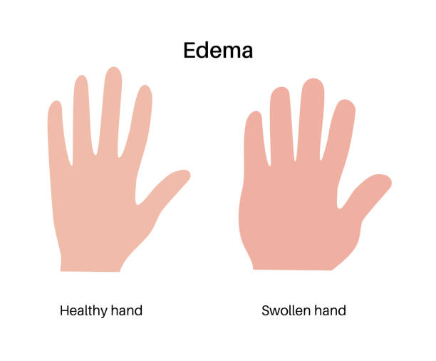 Edema of arm Edema disease concept. Oedema or fluid retention disorder. Inflammation in arms. Hydropsy, swelling and build up of fluid in the human body. Heavy and tight feeling in limbs vector illustration. obese joint pain stock illustrations