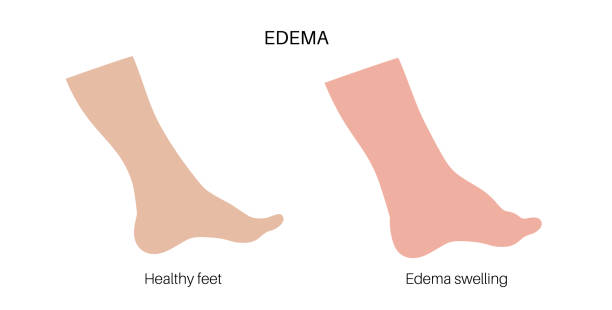 Edema of feet Edema disease concept. Oedema or fluid retention disorder. Inflammation in legs. Hydropsy, swelling and build up of fluid in the human body. Heavy and tight feeling in limbs vector illustration. obese joint pain stock illustrations