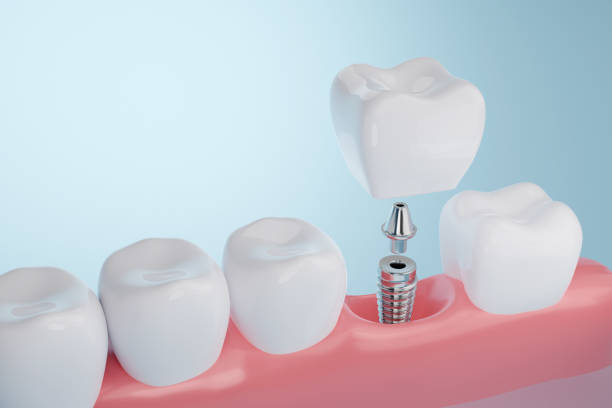 implante dental - teeth implant fotografías e imágenes de stock